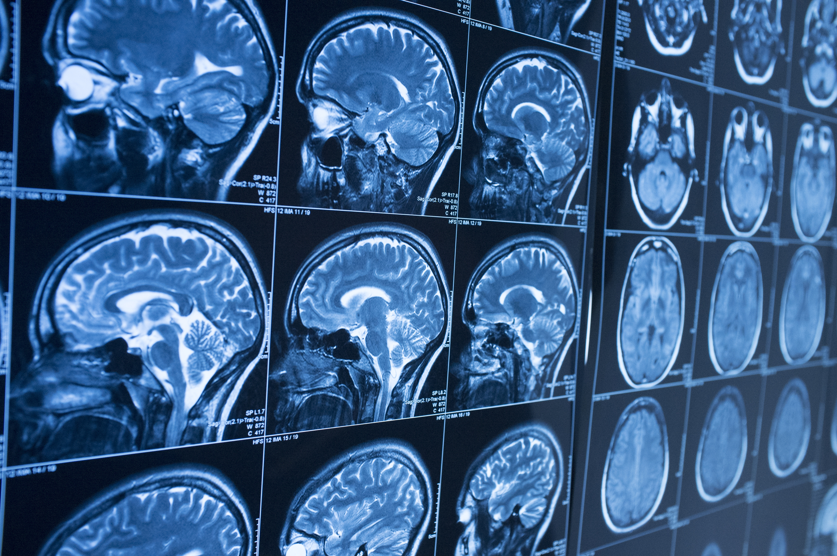 Can Low Sodium Levels Cause Brain Damage? Understanding Hyponatremia and Its Risks